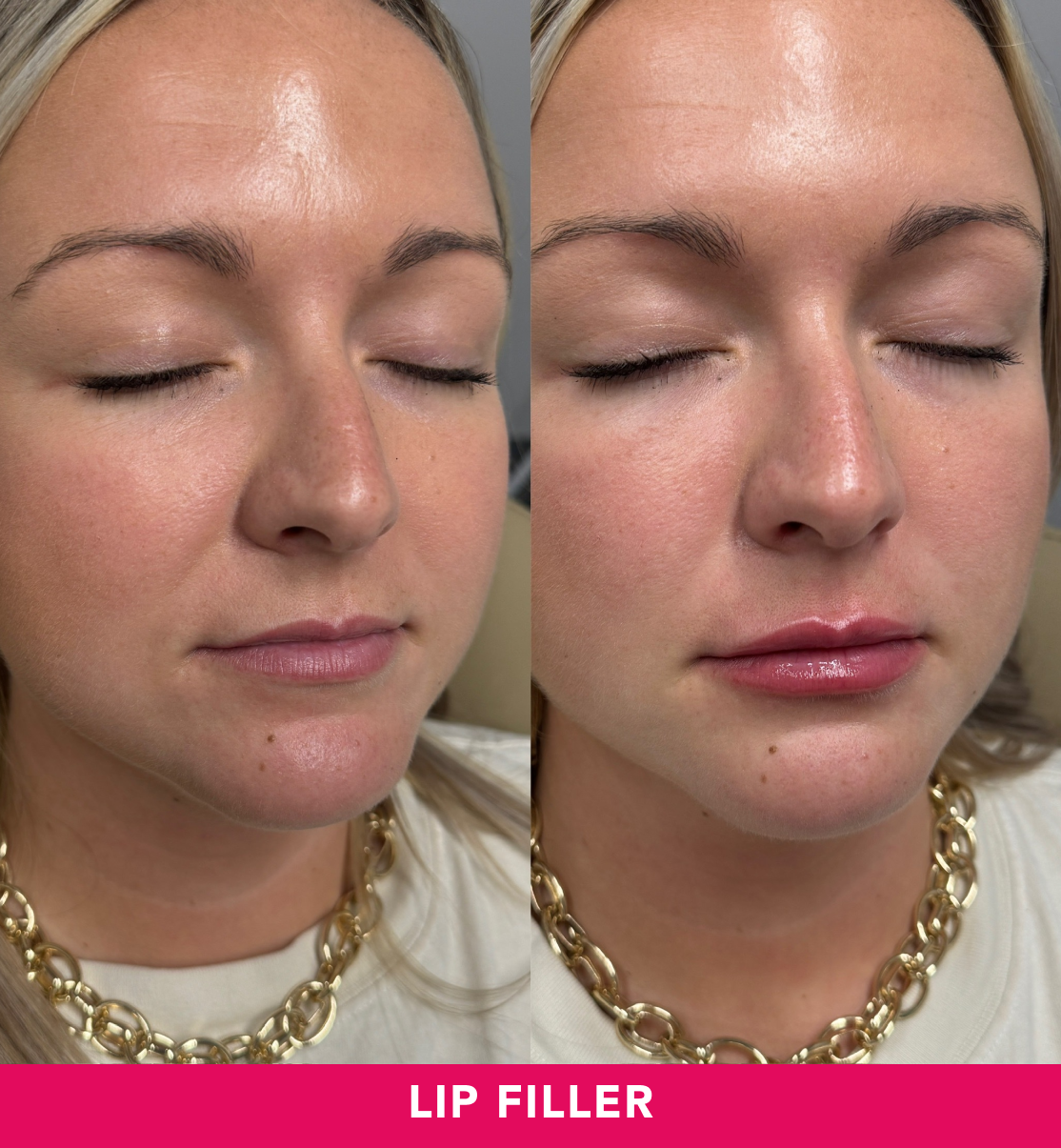Lip Filler