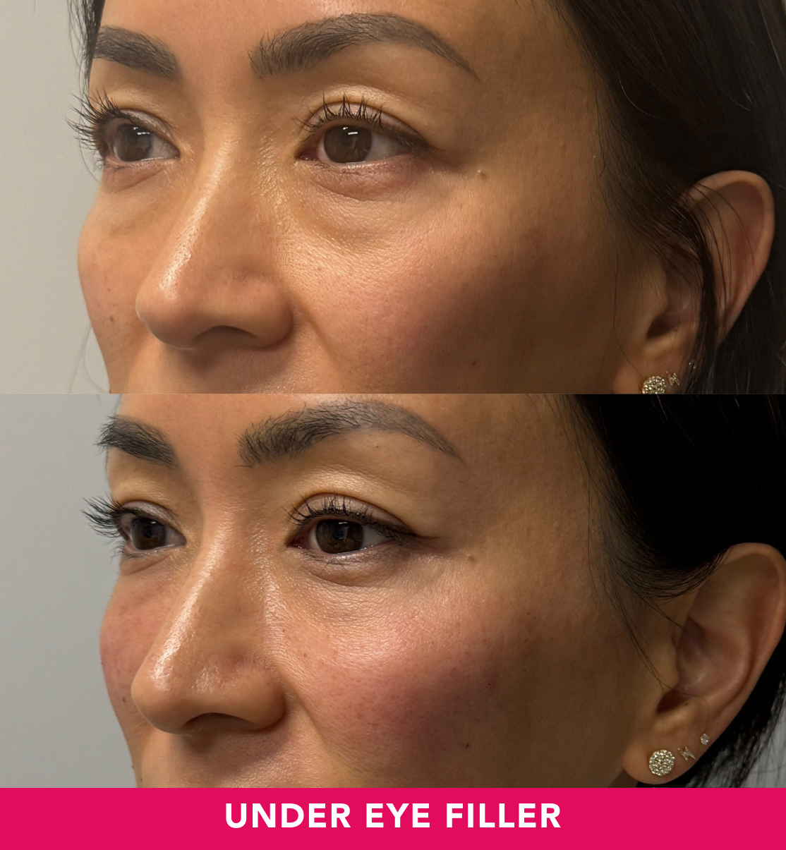 Under Eye Filler