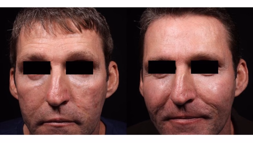 Aerolase - Before and After-1