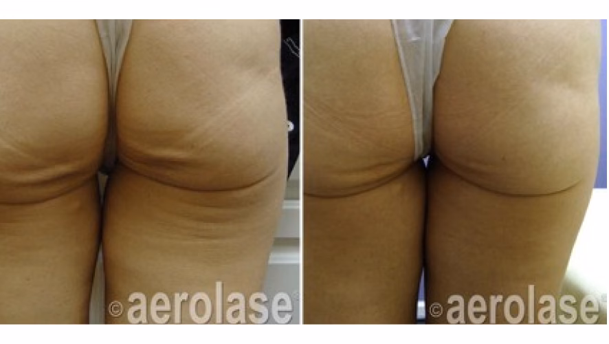 Aerolase - Before and After-2