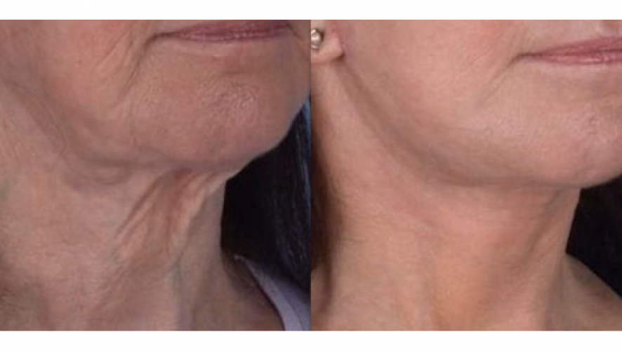 Aerolase - Before and After