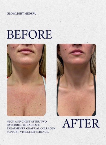 Glowlight Med Spa - Before and After