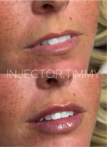 Glowlight Med Spa - Before and After