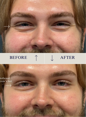 Glowlight Med Spa - Before and After