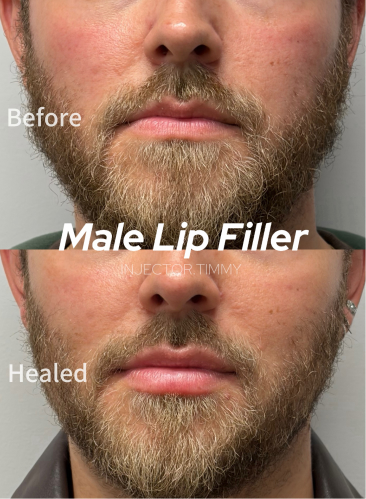 Glowlight Med Spa - Before and After Male Lip Filler