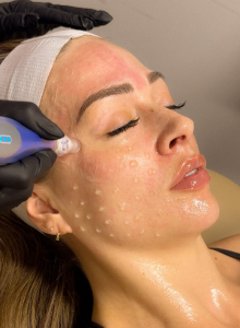 Glowlight Med Spa Woodinville WA